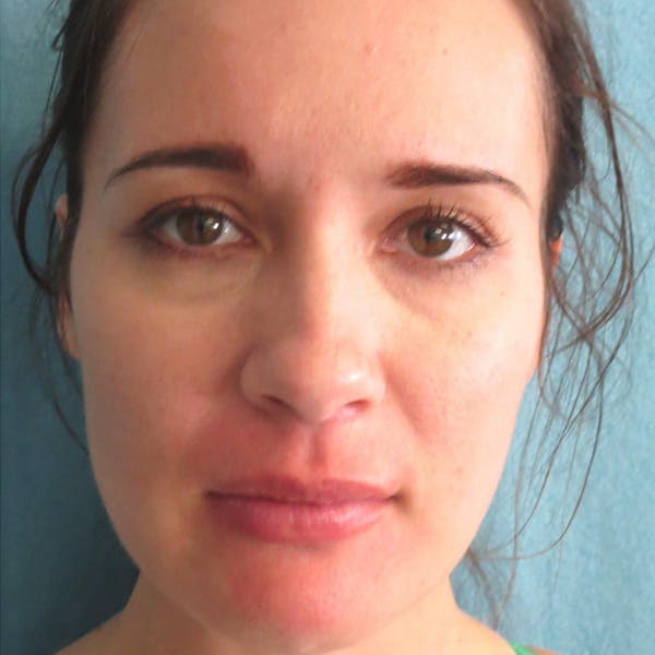 Dermal Fillers Before & After Gallery - Patient 4751965 - Image 2