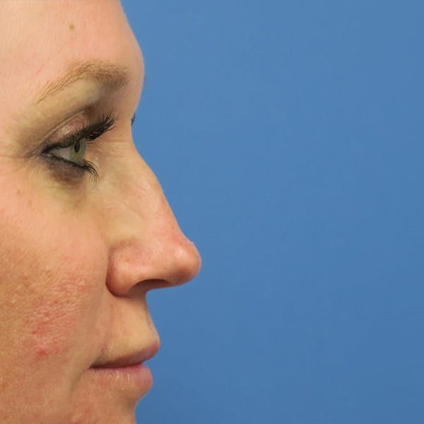 Dermal Fillers Before & After Gallery - Patient 4751967 - Image 1