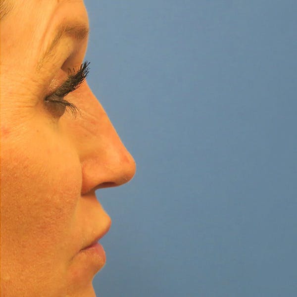 Dermal Fillers Before & After Gallery - Patient 4751967 - Image 2