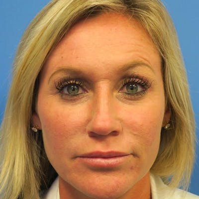 Dermal Fillers Before & After Gallery - Patient 4751967 - Image 4