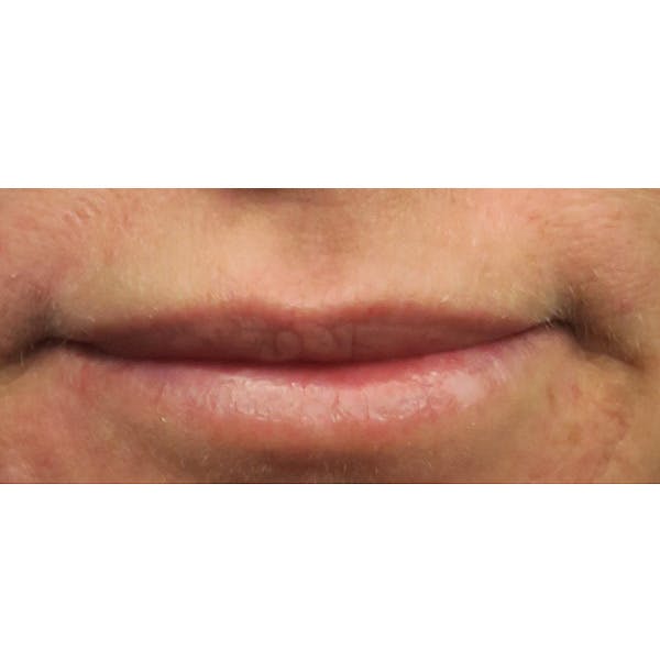 Dermal Fillers Before & After Gallery - Patient 4751968 - Image 1