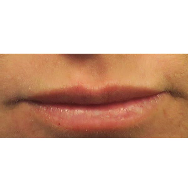 Dermal Fillers Before & After Gallery - Patient 4751968 - Image 2