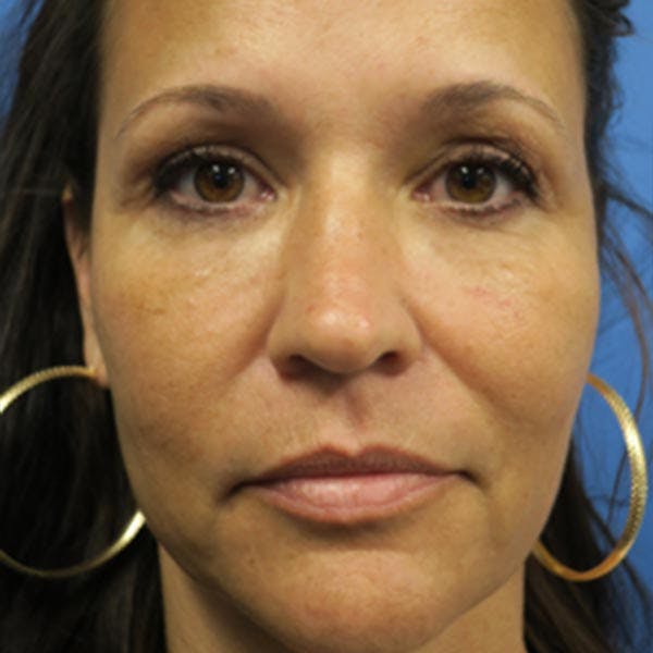 Eyelid Surgery Before & After Gallery - Patient 4751977 - Image 2