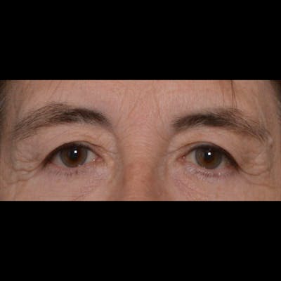 Eyelid Surgery Before & After Gallery - Patient 4751978 - Image 1