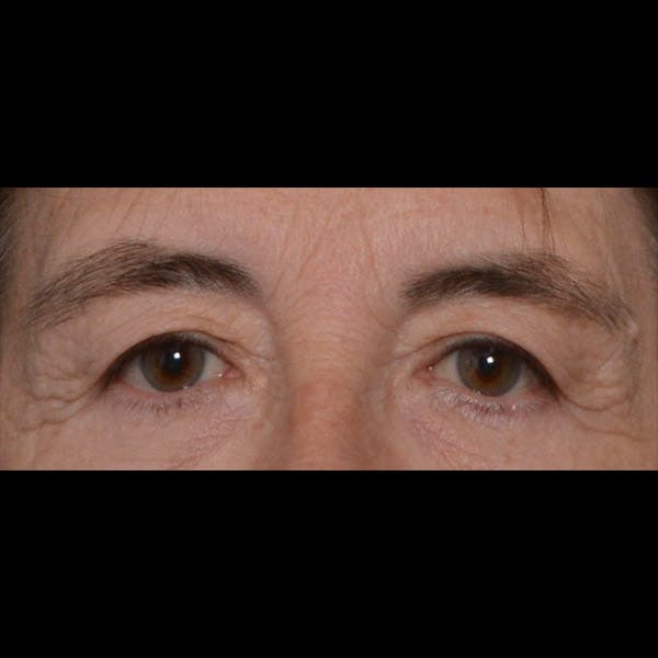 Eyelid Surgery Before & After Gallery - Patient 4751978 - Image 1