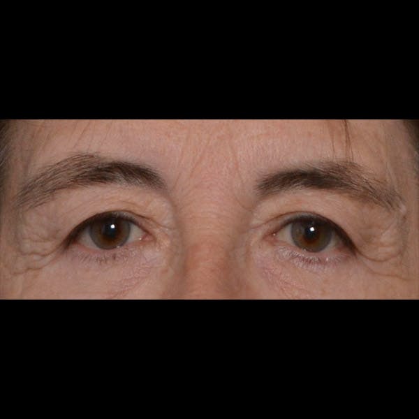 Eyelid Surgery Gallery - Patient 4751978 - Image 1