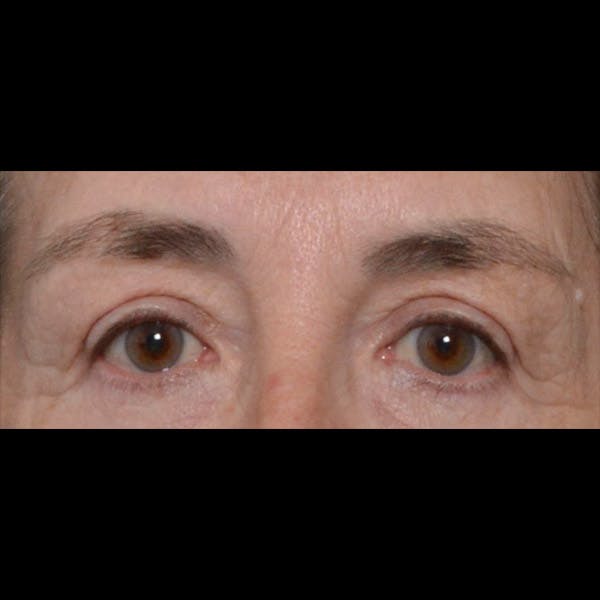 Eyelid Surgery Before & After Gallery - Patient 4751978 - Image 2