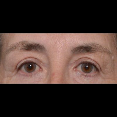 Eyelid Surgery Before & After Gallery - Patient 4751978 - Image 2