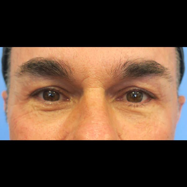 Eyelid Lift Before & After 01
