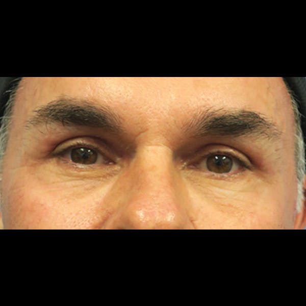 Eyelid Surgery Before & After Gallery - Patient 4751979 - Image 2