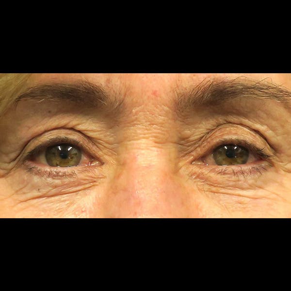Eyelid Surgery Before & After Gallery - Patient 4751981 - Image 1