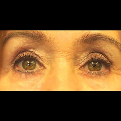 Eyelid Surgery Before & After Gallery - Patient 4751981 - Image 2