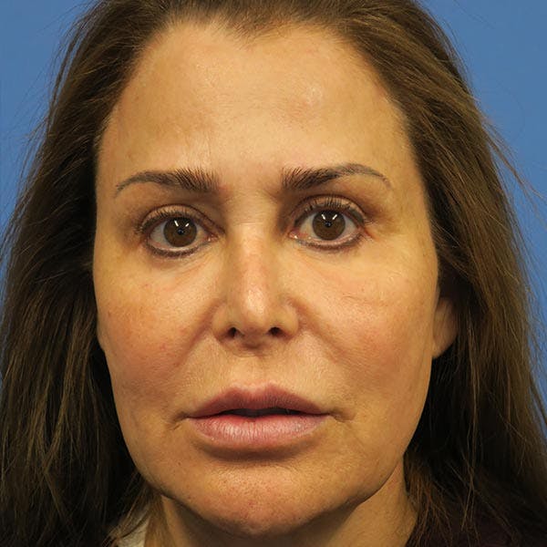 Facelift Before & After Gallery - Patient 4751983 - Image 1