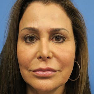 Before & After Photos of Facelift in Santa Barbara, CA