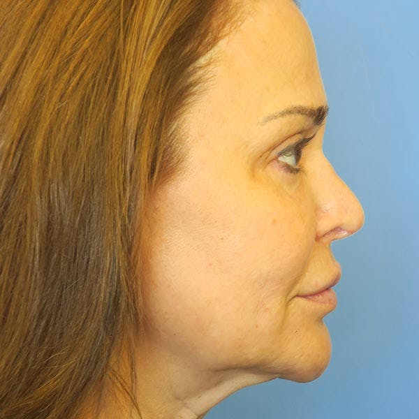 Facelift Before & After Gallery - Patient 4751983 - Image 3