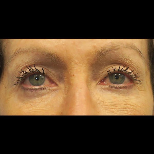 Eyelid Surgery Before & After Gallery - Patient 4751982 - Image 1