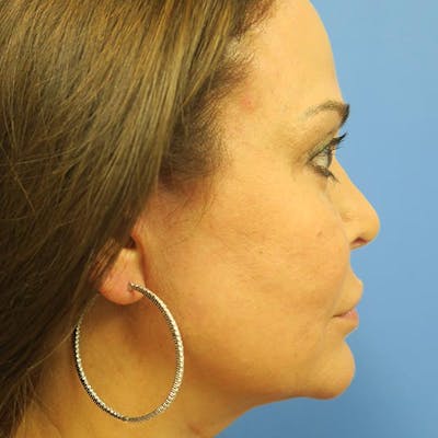 Facelift Before & After Gallery - Patient 4751983 - Image 4