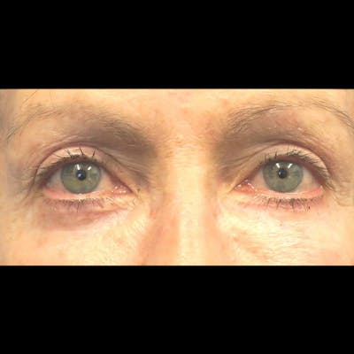 Eyelid Surgery Before & After Gallery - Patient 4751982 - Image 2