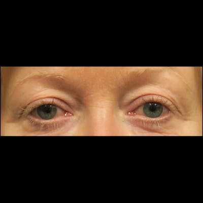 Eyelid Surgery Before & After Gallery - Patient 4751984 - Image 1