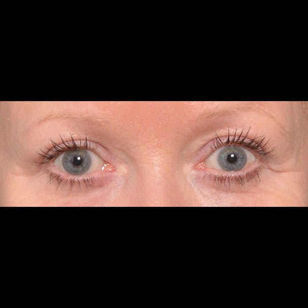 Eyelid Surgery Before & After Gallery - Patient 4751984 - Image 2