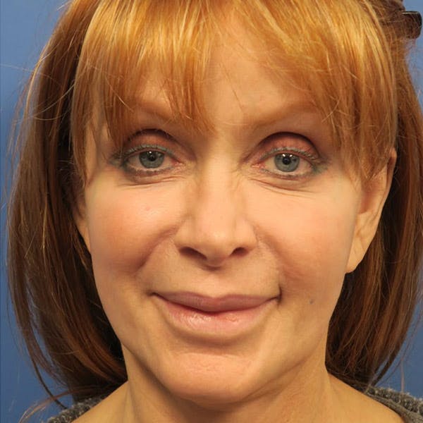 Facelift Before & After Gallery - Patient 4751986 - Image 1