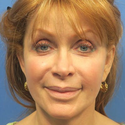 Facelift Before & After Gallery - Patient 4751986 - Image 2