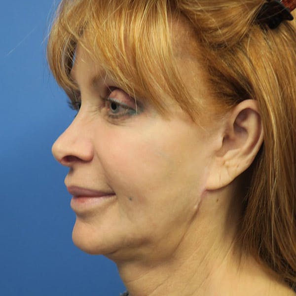 Facelift Before & After Gallery - Patient 4751986 - Image 3