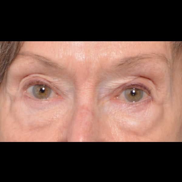 Eyelid Surgery Before & After Gallery - Patient 4751985 - Image 1