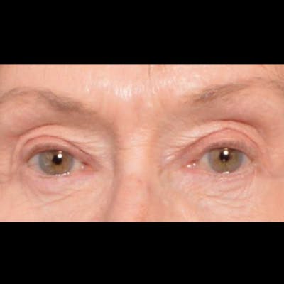 Eyelid Surgery Before & After Gallery - Patient 4751985 - Image 2