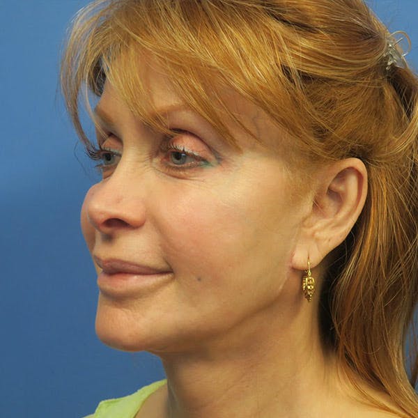 Facelift Before & After Gallery - Patient 4751986 - Image 4