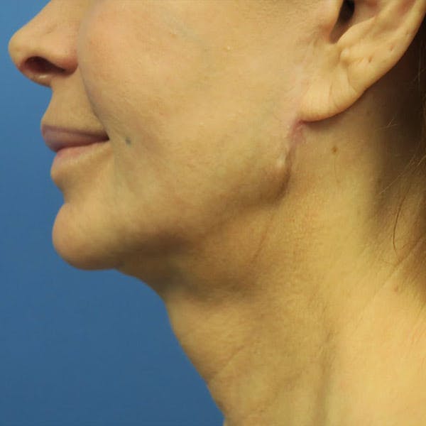 Facelift Before & After Gallery - Patient 4751986 - Image 5