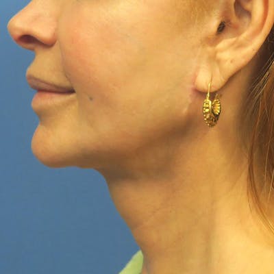 Facelift Before & After Gallery - Patient 4751986 - Image 6