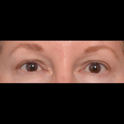 Eyelid Surgery Gallery - Patient 4751987 - Image 1