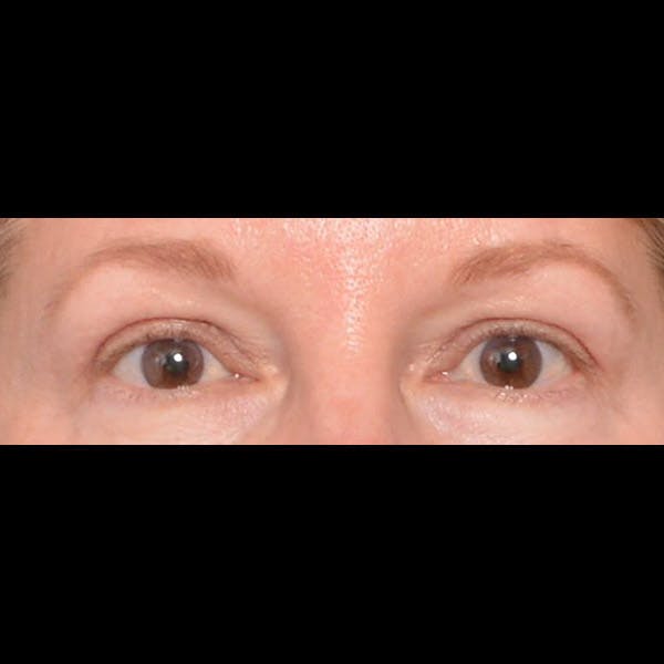 Eyelid Surgery Before & After Gallery - Patient 4751987 - Image 2