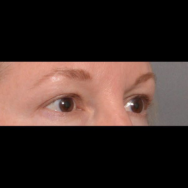 Eyelid Surgery Before & After Gallery - Patient 4751987 - Image 3