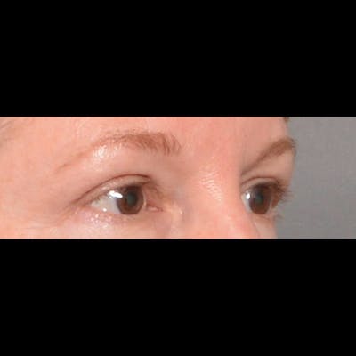Eyelid Surgery Before & After Gallery - Patient 4751987 - Image 4