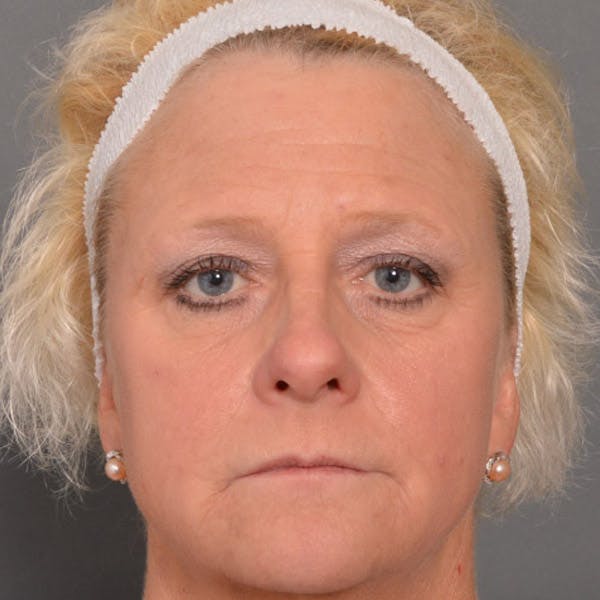 Facelift Before & After Gallery - Patient 4751989 - Image 1