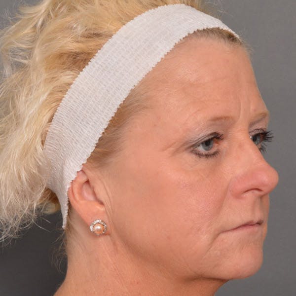 Facelift Before & After Gallery - Patient 4751989 - Image 3