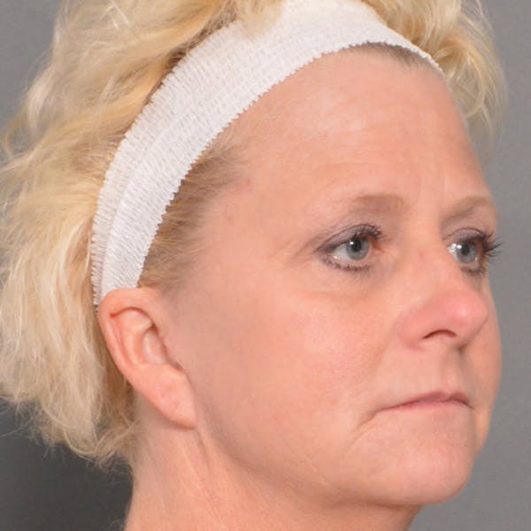 Facelift Before & After Gallery - Patient 4751989 - Image 4
