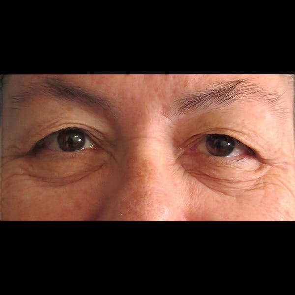Eyelid Surgery Gallery - Patient 4751995 - Image 1