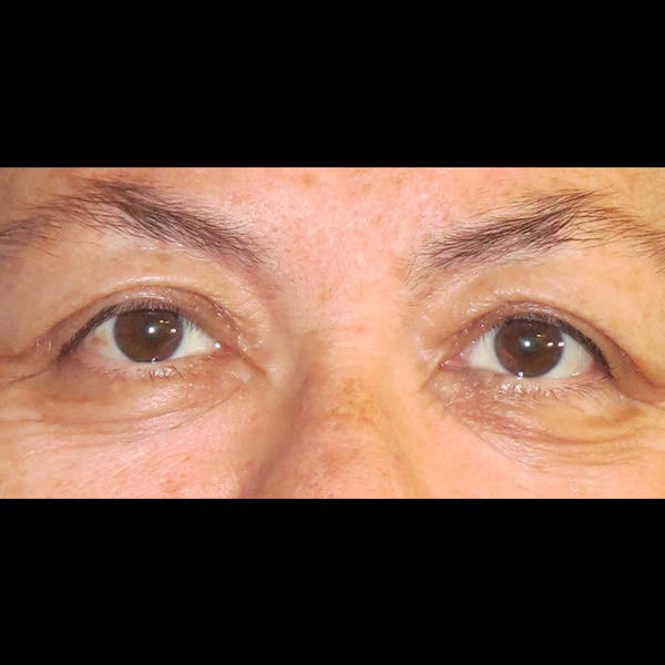 Eyelid Surgery Before & After Gallery - Patient 4751995 - Image 2