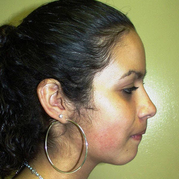 Facial Reconstruction Before & After Gallery - Patient 4751999 - Image 2