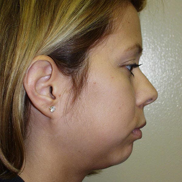Facial Reconstruction Gallery - Patient 4752002 - Image 1