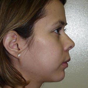 Facial Reconstruction