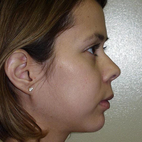 Facial Reconstruction Gallery - Patient 4752002 - Image 2