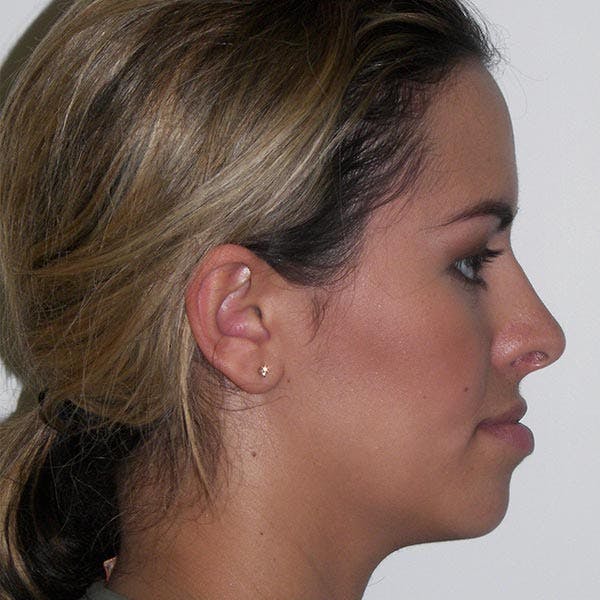 Facial Reconstruction Before & After Gallery - Patient 4752003 - Image 3