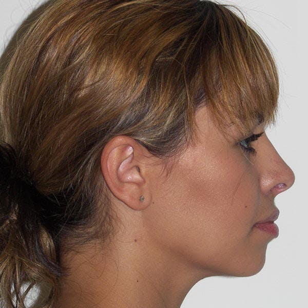 Facial Reconstruction Before & After Gallery - Patient 4752003 - Image 4
