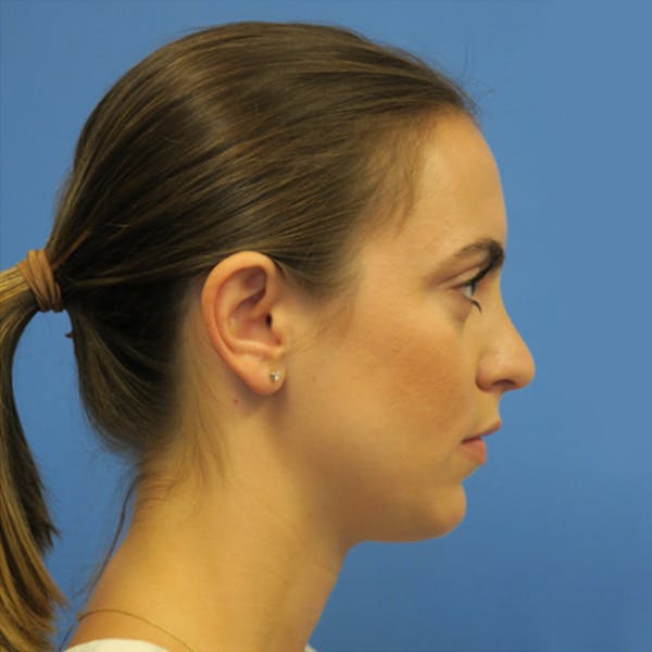Kybella Before & After Gallery - Patient 4752014 - Image 1