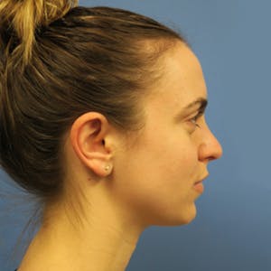 Kybella