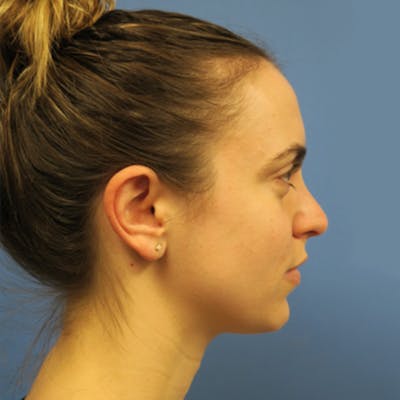 Kybella Before & After Gallery - Patient 4752014 - Image 2